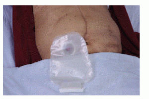 An ostomy appliance is worn over the stoma to collect the feces
