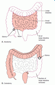 Some of the people you will care for may have had surgery to remove all or part of the large intestine. Such a surgery may be necessary because of cancer, a bowel obstruction, or trauma. (A) Ileostomy. The entire large intestine is removed. A stoma is made in the abdominal wall, and the end of the small intestine (the ileum) is sewn into place. (B) Colostomy. Part of the large intestine is removed. A colostomy can be done at any point along the large intestine; here, a section of the descending colon was removed. A stoma is made in the abdominal wall, and the healthy end of the remaining large intestine is sewn into place