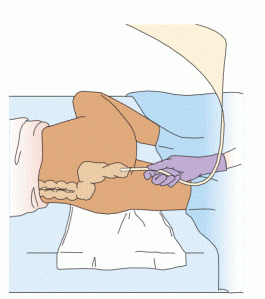 The left Sims’ position is used when a person is to receive an enema. This position exposes the greatest amount of the bowel to the enema solution.
